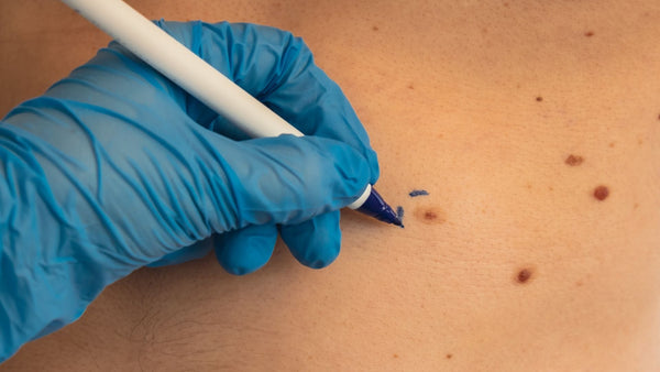 Lamprobe Skin Tag Removal: What Fredericksburg, Stafford & Woodbridge Clients Should Know